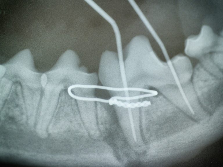 Root Canal therapy after jaw fracture repair